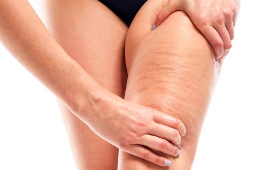 Celulitis (producto del sobre peso)