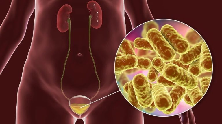 Cistitis