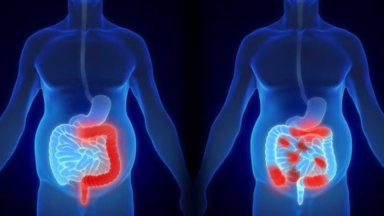 Colitis