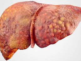 Cirrosis