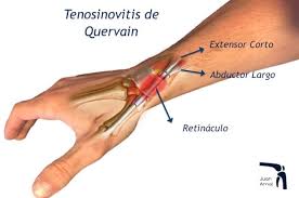Tendinitis