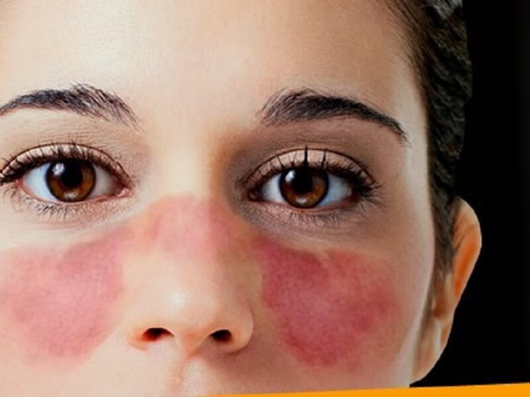 Lupus (LES)